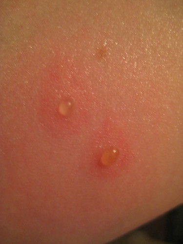 Despite their name, they can live practically anywhere, like on b. SYMPTOMS OF BED BUG BITES