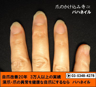 爪が離れる症状 自爪矯正の変化画像 病院で治らなかった爪の病気も健康的な爪に治すブログ 爪が離れる症状 自爪矯正の変化画像 病院で治らなかった爪の病気も健康的な爪に治すブログ