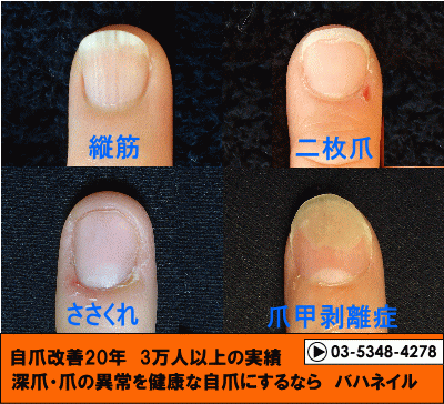 ジェルネイルによる爪トラブル 病院で治らなかった爪の病気も健康的な爪に治すブログ