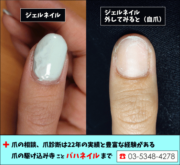 セルフジェルネイルで傷んだ爪の治し方計画 ネイルケア編 病院 セルフジェルネイルで傷んだ爪の治し方計画 ネイルケア編 病院