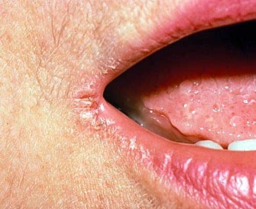 Chapped lips are covered in a layer of dry skin that can prevent healing ingredients in lip balms from reaching the right . Angular Cheilitis Treatment Causes How To Get Rid Of It