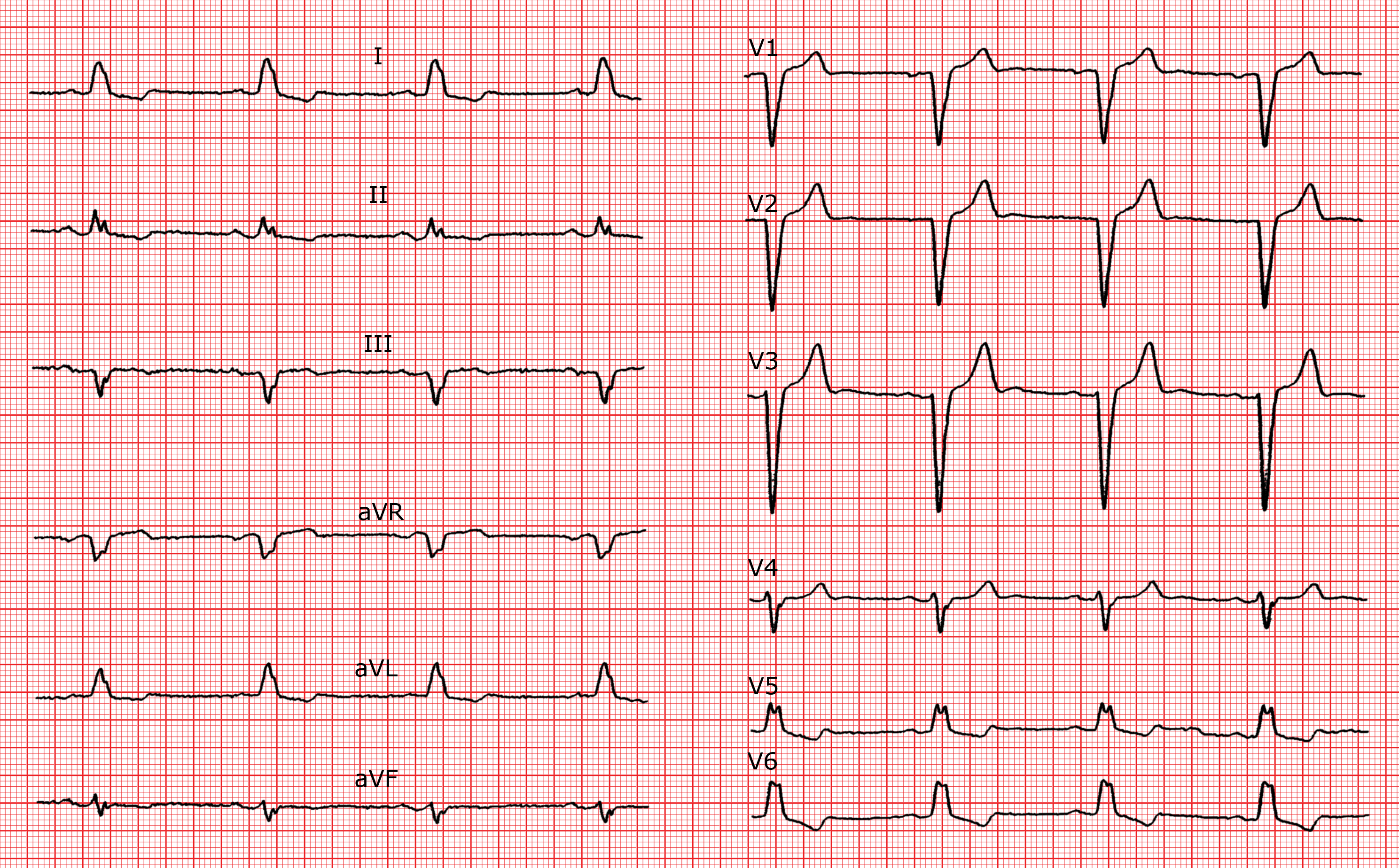 Troubles De Conduction Intraventriculaire Ecg