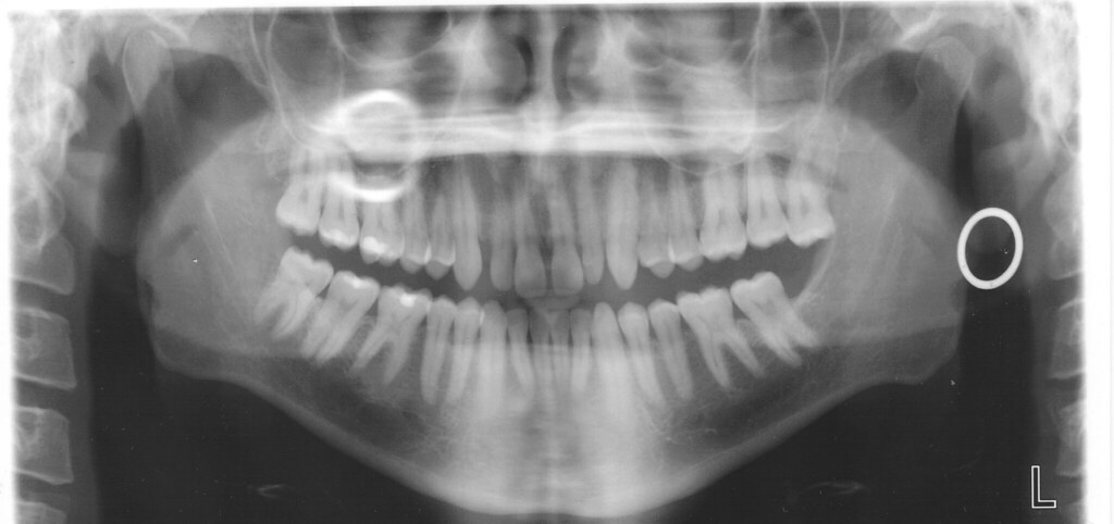 There are multiple options for people who would r. teeth | Full mouth x-ray that I got prior to having my