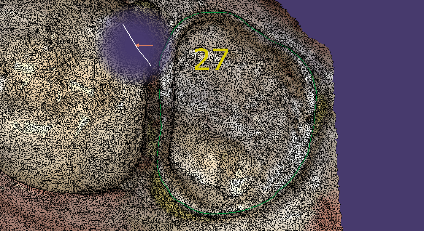 digital dentistry cad-ray exocad design software allows you to mark your margins