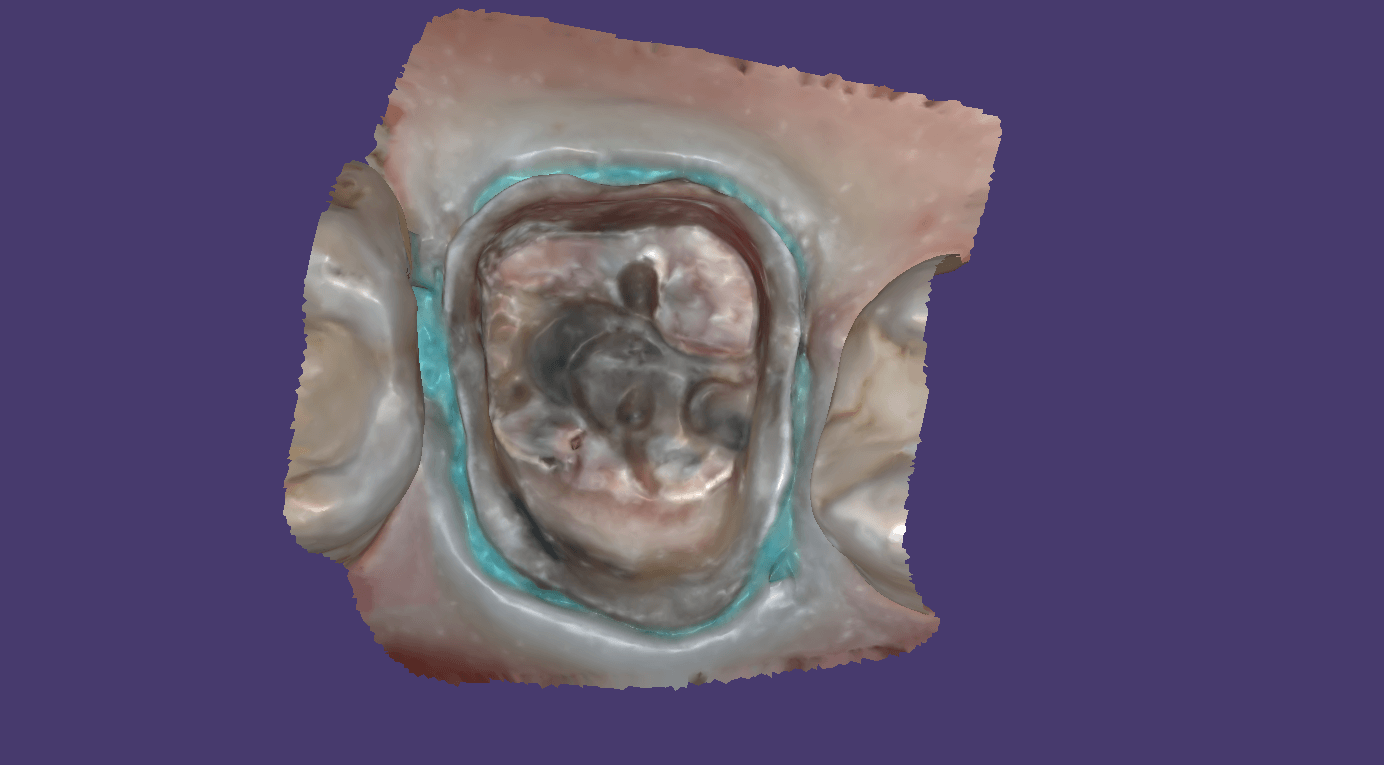 digital dentistry software cad-ray exocad
