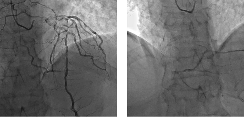 Шунтирование и стентирование что лучше. Шунтирование и стентирование сосудов сердца, в чем разница