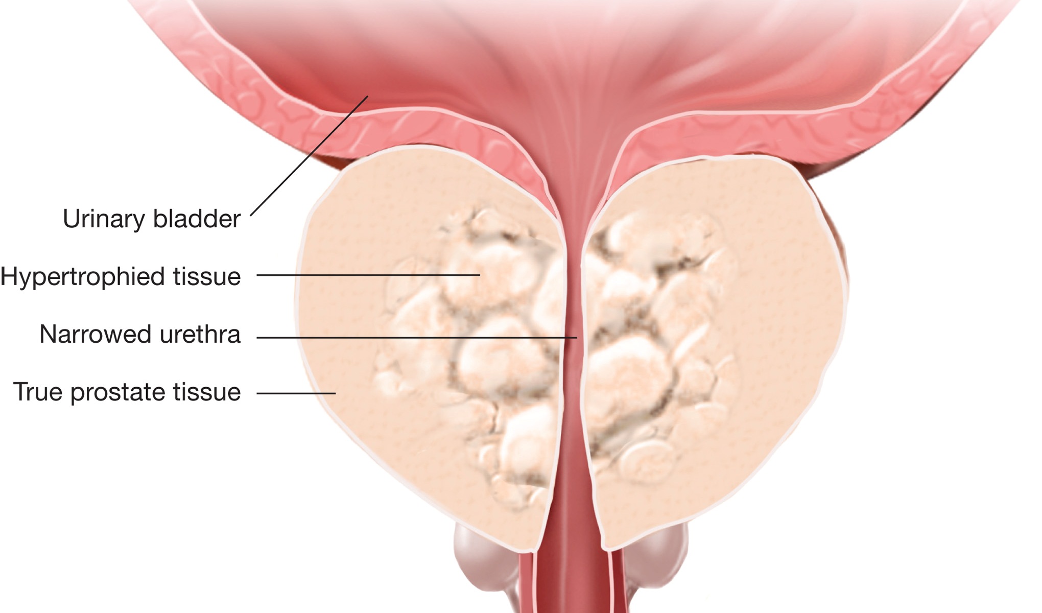 Dalam mendiagnosis pembengkakan prostat jinak (bph), dokter akan menanyakan gejala yang dirasakan oleh pasien dan kemudian untuk mengetahui ukuran kelenjar . Pembesaran Prostat Jinak Bph Penyebab Dan Gejala