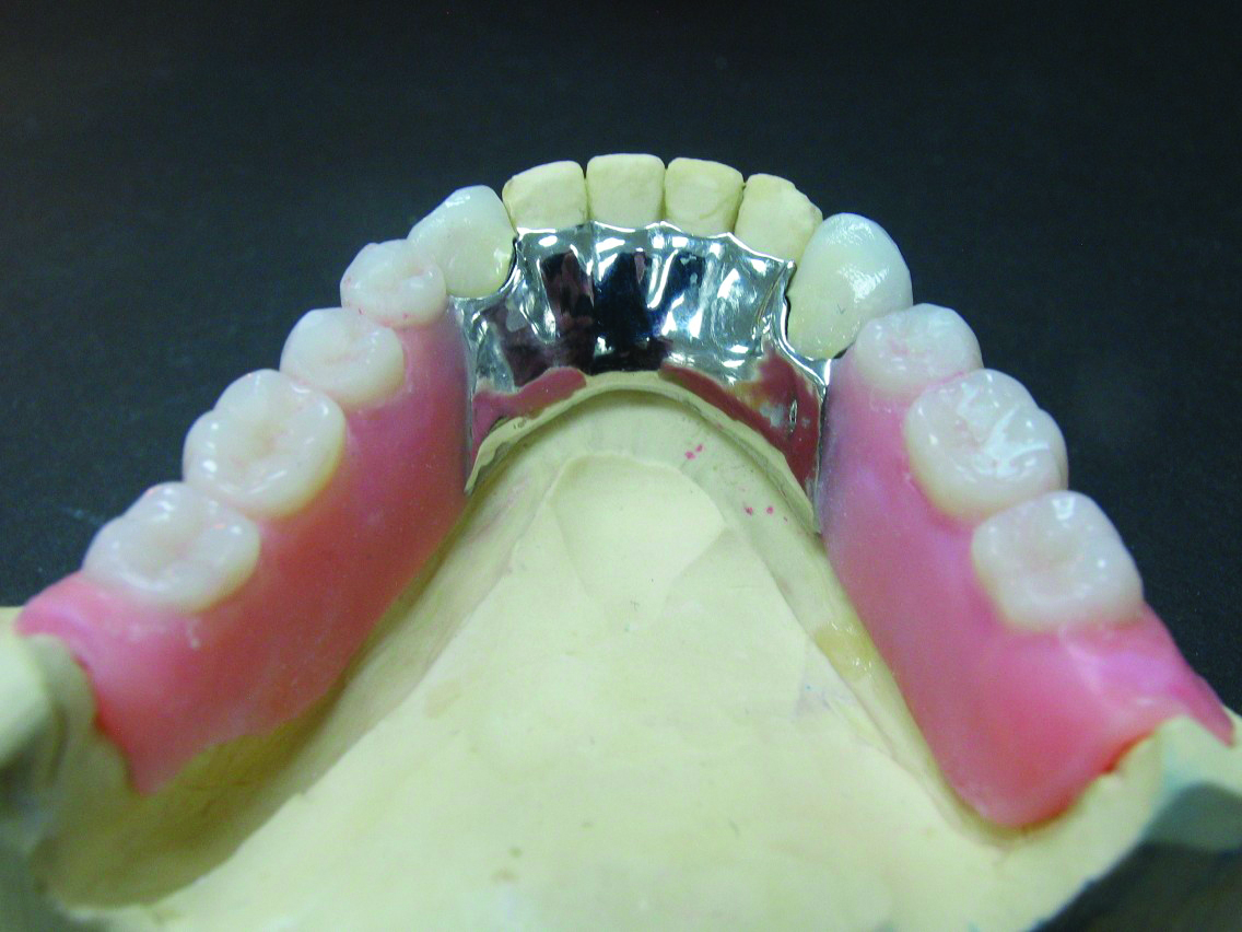Distal Extension Denture Base Definition  - Maximum Extension Of Denture Base.