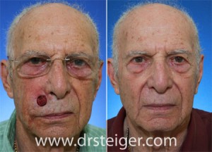 2 artikel zum thema estlander. MOHS Surgery Reconstruction Before and After Photos