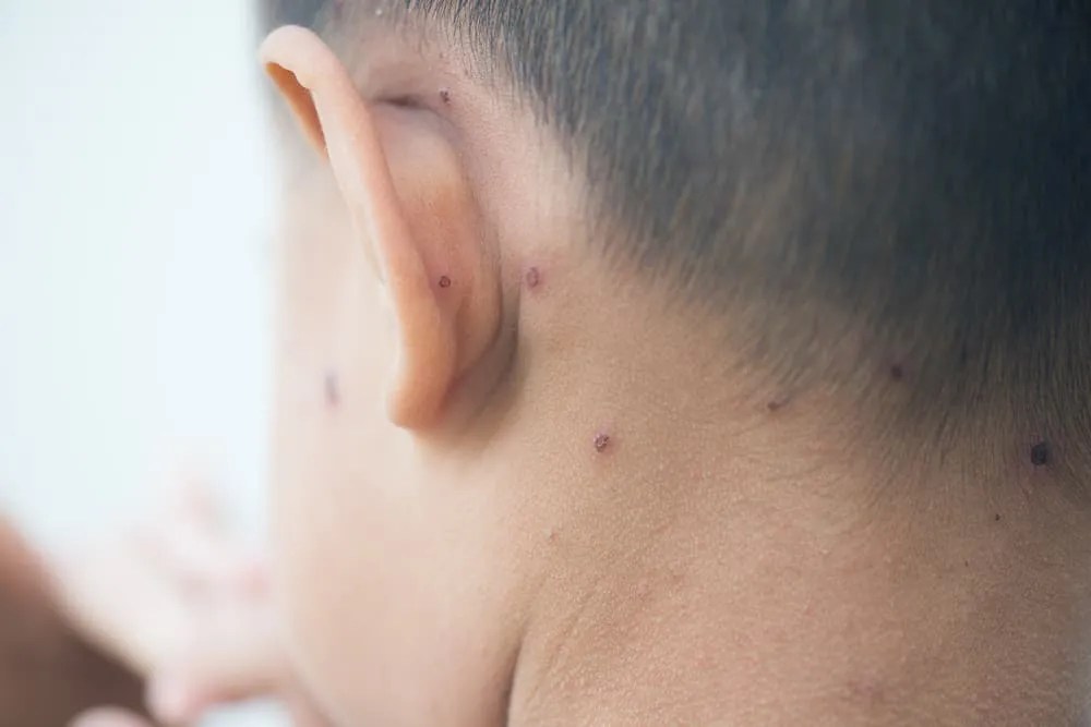 Reaksi alergi terhadap obat atau makanan tertentu; Cara Menghilangkan Gatal Cacar Air Untuk Menghindari Infeksi Kulit