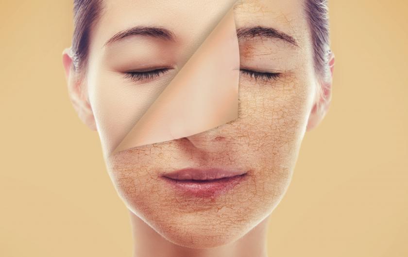 Pilih pelembap yang tepat · jaga asupan cairan · konsumsi lebih banyak buah dan sayuran · konsumsi vitamin · jangan lupa pelembap wajah. Kulit Wajah Kering Bisa Diatasi Dengan 5 Langkah Mudah Ini
