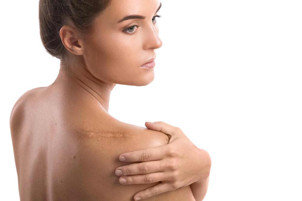 Keloid merupakan bekas luka yang tumbuh melebar dan menonjol dari permukaan kulit. Penyebab Dan Cara Menghilangkan Keloid Hello Sehat