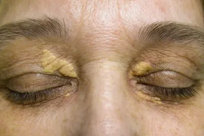 Xanthelasma, Penyebab Adanya Lemak di Dekat Kelopak Mata | Hello Sehat
