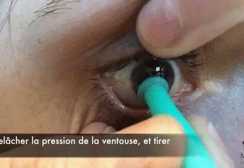 Ventouse Pour Retrait des Lentilles ( 2 pièces ) - Eprimoo
