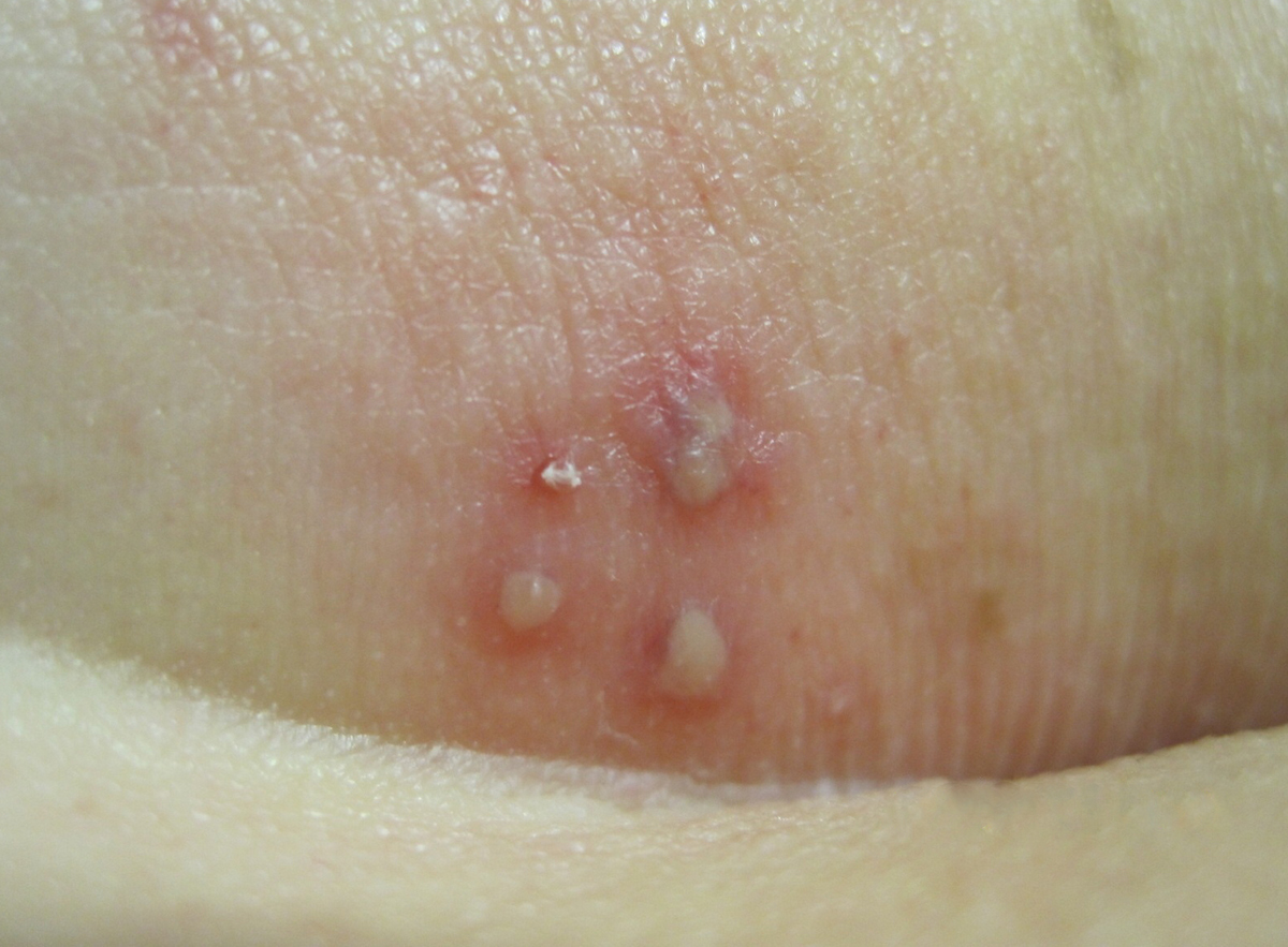 Authoritative facts about the skin from dermnet new zealand. Core Concepts Genital Herpes Self Study Lessons 2nd Edition National Std Curriculum