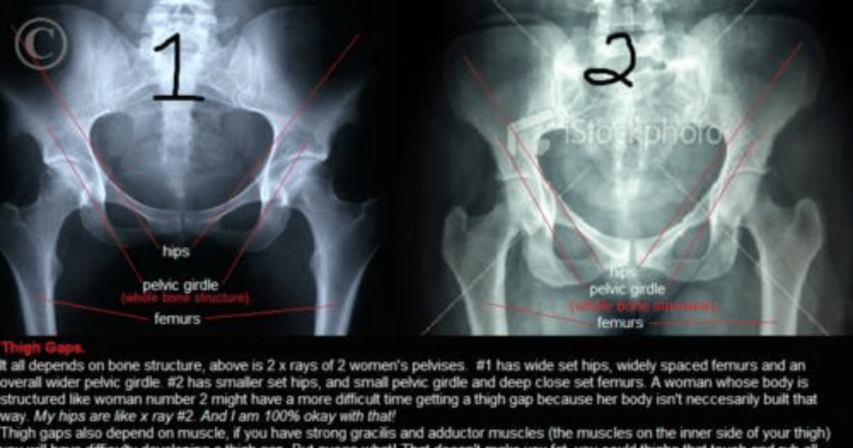 The human body has more than 200 bones. Thigh Gap Is All About Bone Structure Girlsaskguys