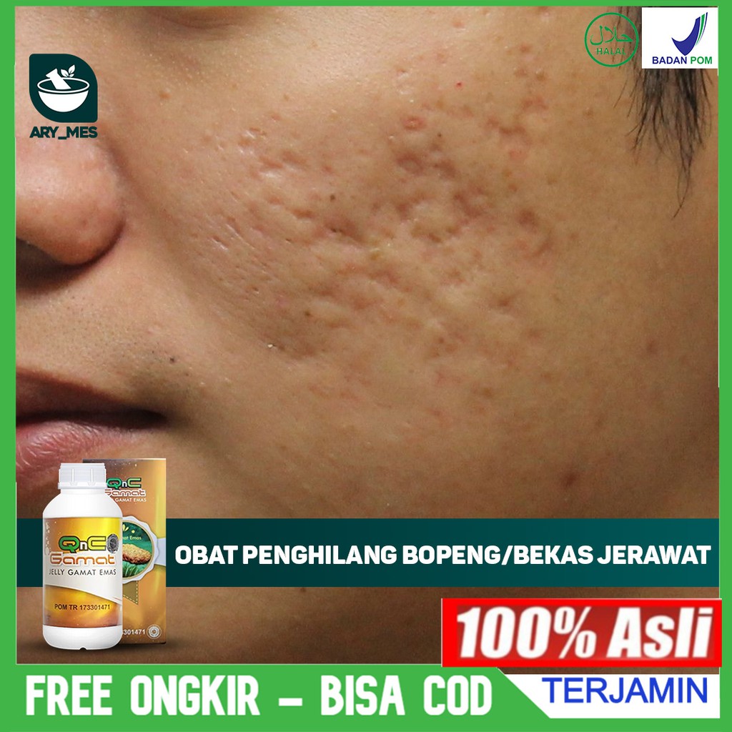 Salah satu perawatan yang sering direkomendasikan sebagai cara menghilangkan bopeng bekas jerawat adalah dermal filler. Jual Obat Penghilang Bopeng Penghilang Bekas Jerawat Pembersih Wajah Kulit Jadi Halus Qnc Jelly Gamat Indonesia Shopee Indonesia
