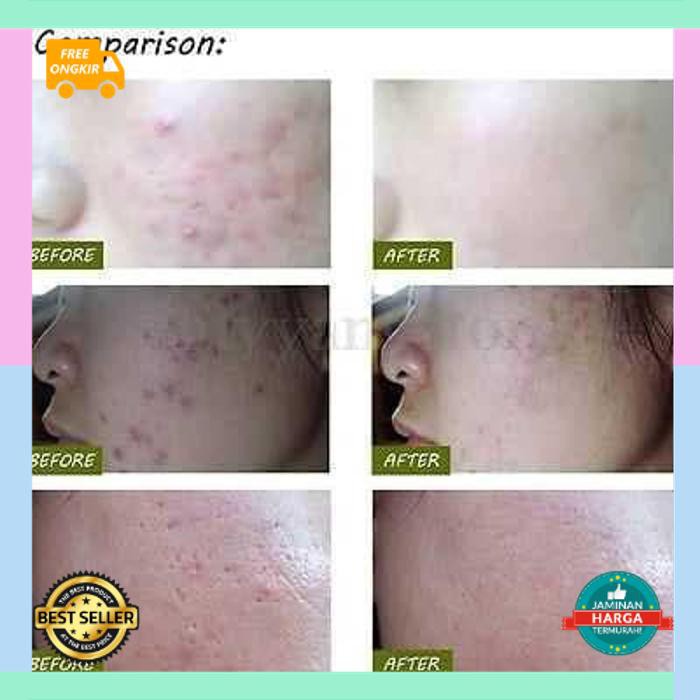 Orang dapat mendiskusikan biaya ini dengan dokter dan perusahaan asuransi mereka. Jual Laser Luka Harga Terbaik Alat Perawatan Wajah Perawatan Kecantikan November 2021 Shopee Indonesia