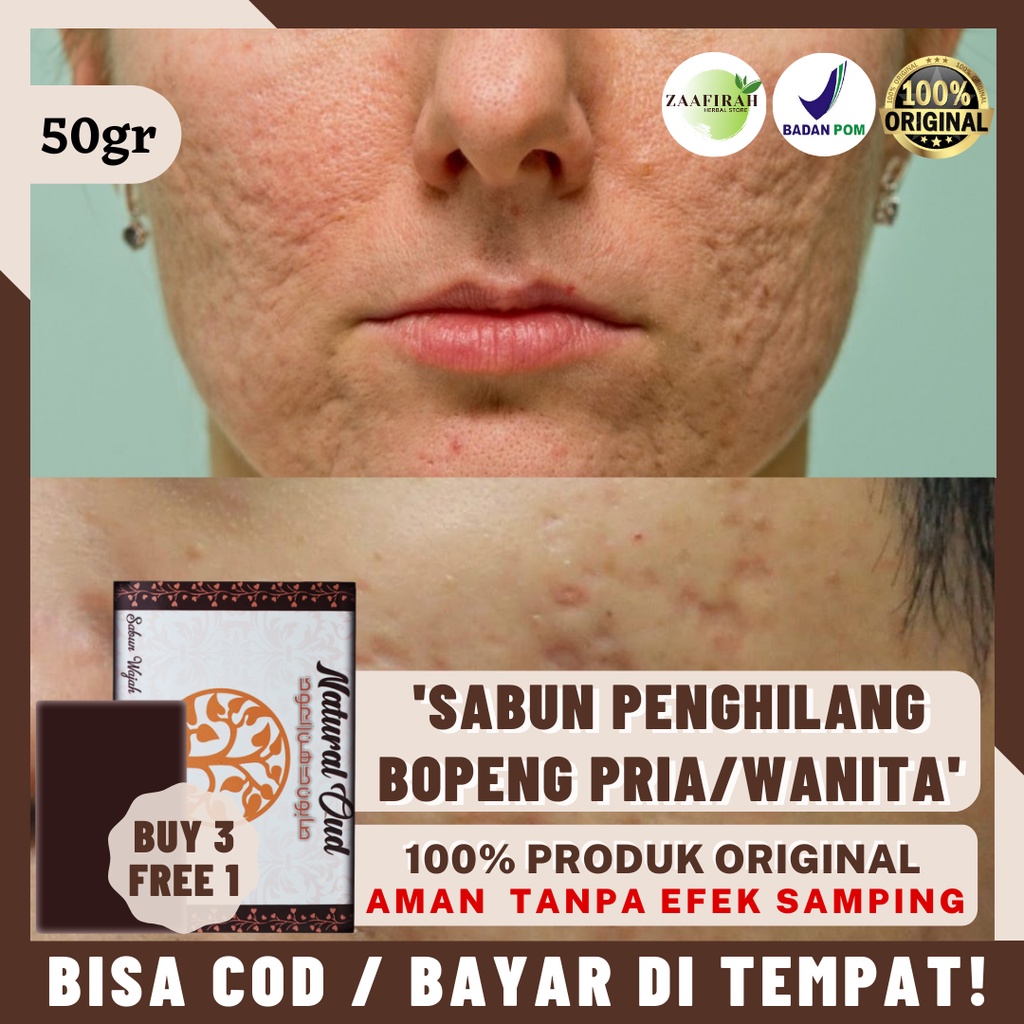 Campuran oatmeal, putih telur, dan air lemon · 3. Jual Sabun Penghilang Bopeng Obat Bopeng Sabun Pemudar Bopeng Menahun Sabun Pembersih Bekas Jerawat Kulit Berlubang Pengecil Pori Pori Besar Penghilang Jerawat Bopeng Bekas Jerawat Batu Jerawat Meradang Bopeng Bekas Cacar Natural