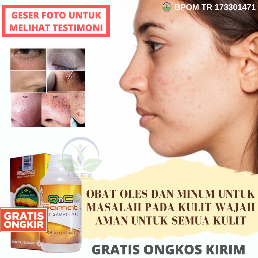 Jelly gamat gold sebagai obat ampuh untuk meratakan dan menghilangkan bopeng bekas jerawat. Jual Jelly Gamat Qnc Berkhasiat Untuk Kecantikan Atasi Jerawat Milia Manfaat Masker Teripang Emas Alami Indonesia Shopee Indonesia