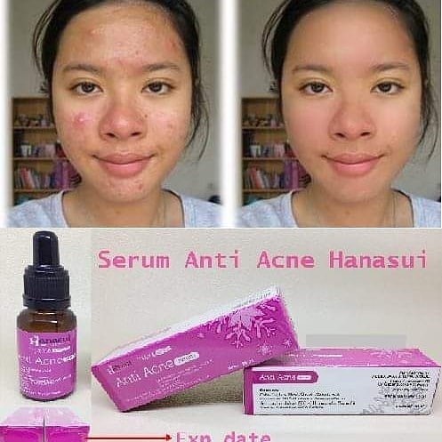 Wajah bruntusan dan berjerawat setelah pakai serum. Serum Anti Jerawat Asli Hanasui Serum Penghilang Jerawat Dan Bekas Jerawat Original Hanasui Shopee Indonesia