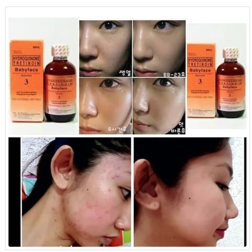 Toner rdl baby face no.2/no.3 kwalitas original. Alkohol Baby Face Rdl Rx3 Toner No 3 Hydroquinone Tretinoin Shopee Indonesia