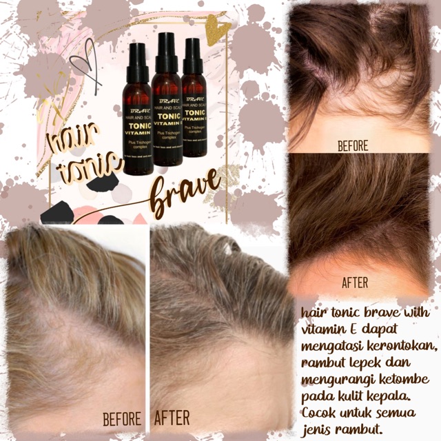 Vitamin d diyakini berperan dalam pertumbuhan rambut, tetapi sebagian . Jual 100 Ml Hair Tonic Brave Vitamin E Serum Vitamin Rambut Rontok Tonic Rambut Obat Rambut Rontok Indonesia Shopee Indonesia