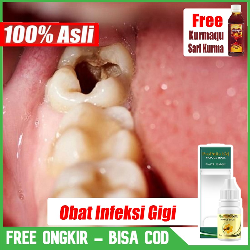 Air garam hangat termasuk pertolongan pertama pada sakit gigi. Jual Obat Infeksi Gigi Abses Gigi Sakit Gigi Radang Gusi Pencegah Gigi Berlubang Propolis Sm Indonesia Shopee Indonesia