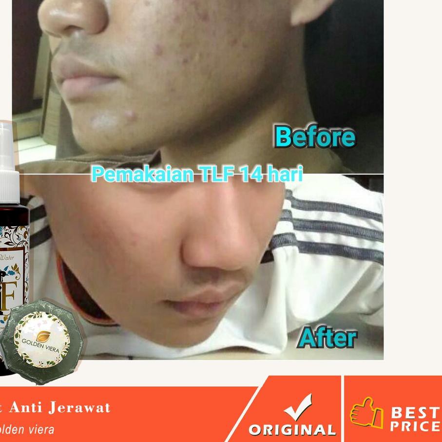 Seperti misalnya makanan, hormonal, kebersihan kulit dan . Jual Trend Kekinian Garansi 2 Minggu Sembuh Obat Jerawat Pria Ampuh Cepat Kering Pembersih Wajah Obat Indonesia Shopee Indonesia