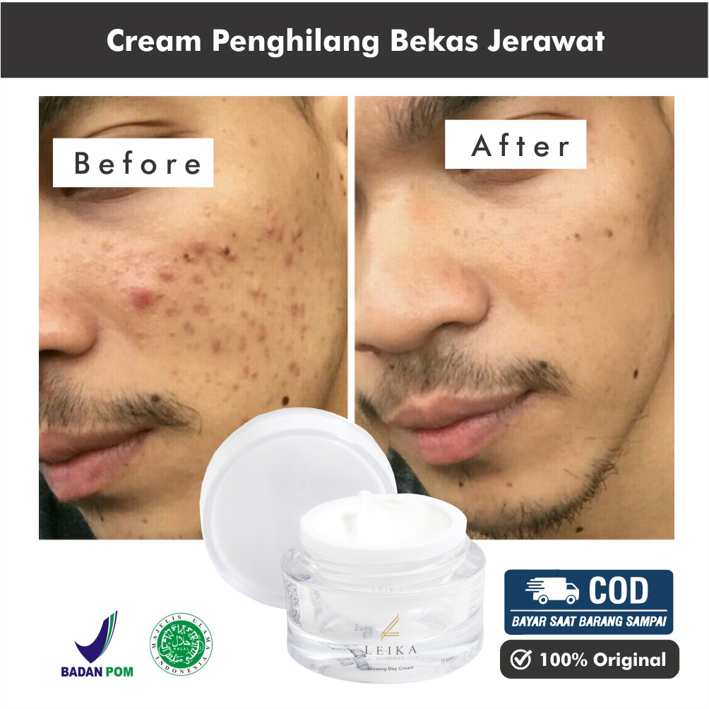 Everwhite acnepair cream · 4. Jual Permanen Krim Penghilang Bekas Jerawat Hitam Pria Ampuh Secara Cepat Aman Bpom Cream Jerawat Ori Indonesia Shopee Indonesia