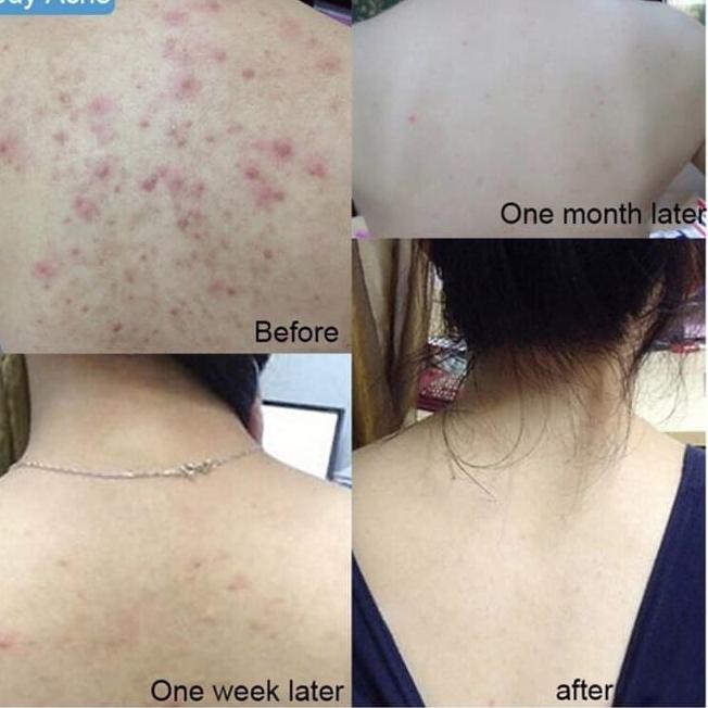 Ganti seprai anda · 5 . Star Seller Sea Salt Soap Sabun Jerawat Menghilangkan Jerawat Punggung Dan Muka Shopee Indonesia