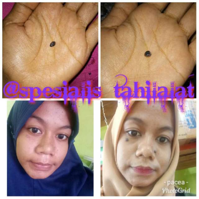 Mengadakan konsultasi dokter kulit & kecantikan, tanpa biaya (syarat. Spesialis Tahi Lalat Penghilang Tahi Lalat Kutil Spesialis Tahilalat Obat Tahi Lalat Kutilos Shopee Indonesia