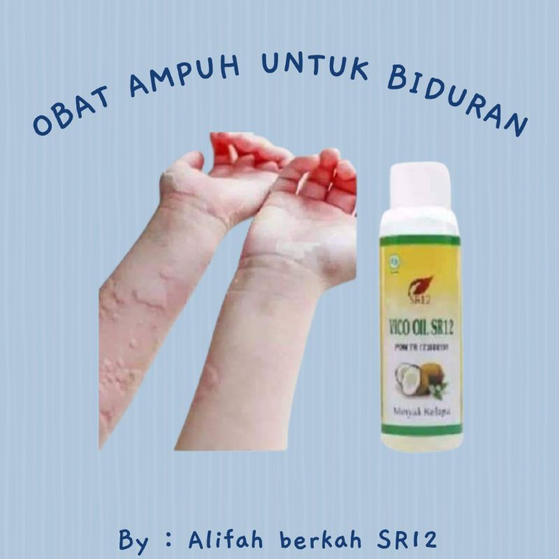 Obat biduran alami di apotik paling ampuh yang khasiatnya sudah terbukti dengan kesakisan langsung dari konsumen yang sembuh yaitu dengan minyak balur sapu . Obat Gatal Alergi Ampuh Biduran Kaligata Obat Alergi Herbal Bpom Sr12 60ml Senilai Rp33 000