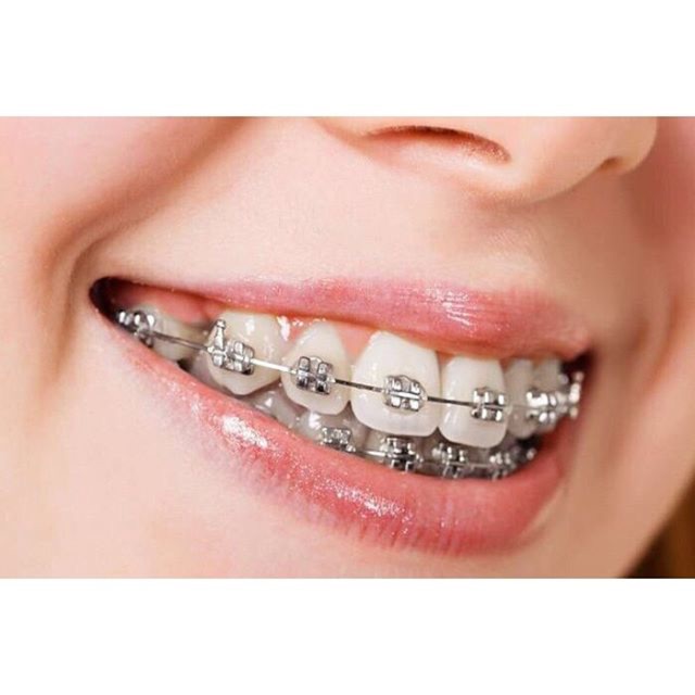 warna karet behel hitam merupakan material pelapis yang sangat populer di indonesia. Behel Lepas Pasang Atas Bawah Warna Bisa Pilih Shopee Indonesia