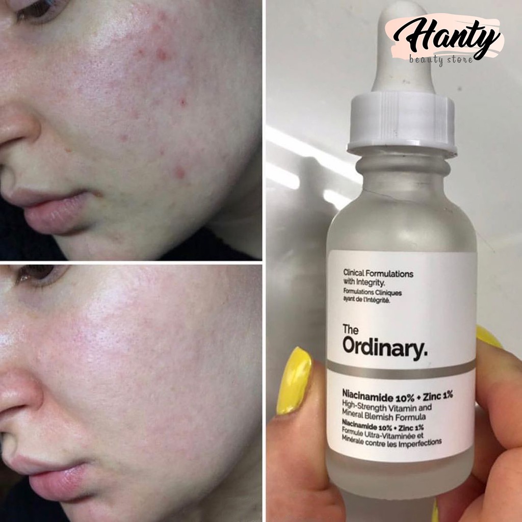 Karena aha dan bha memiliki sifat dan cara kerja yang . Bpom The Ordinary Niacinamide 10 Zinc 1 Jika Palsu Garansi Uang Kembali Shopee Indonesia