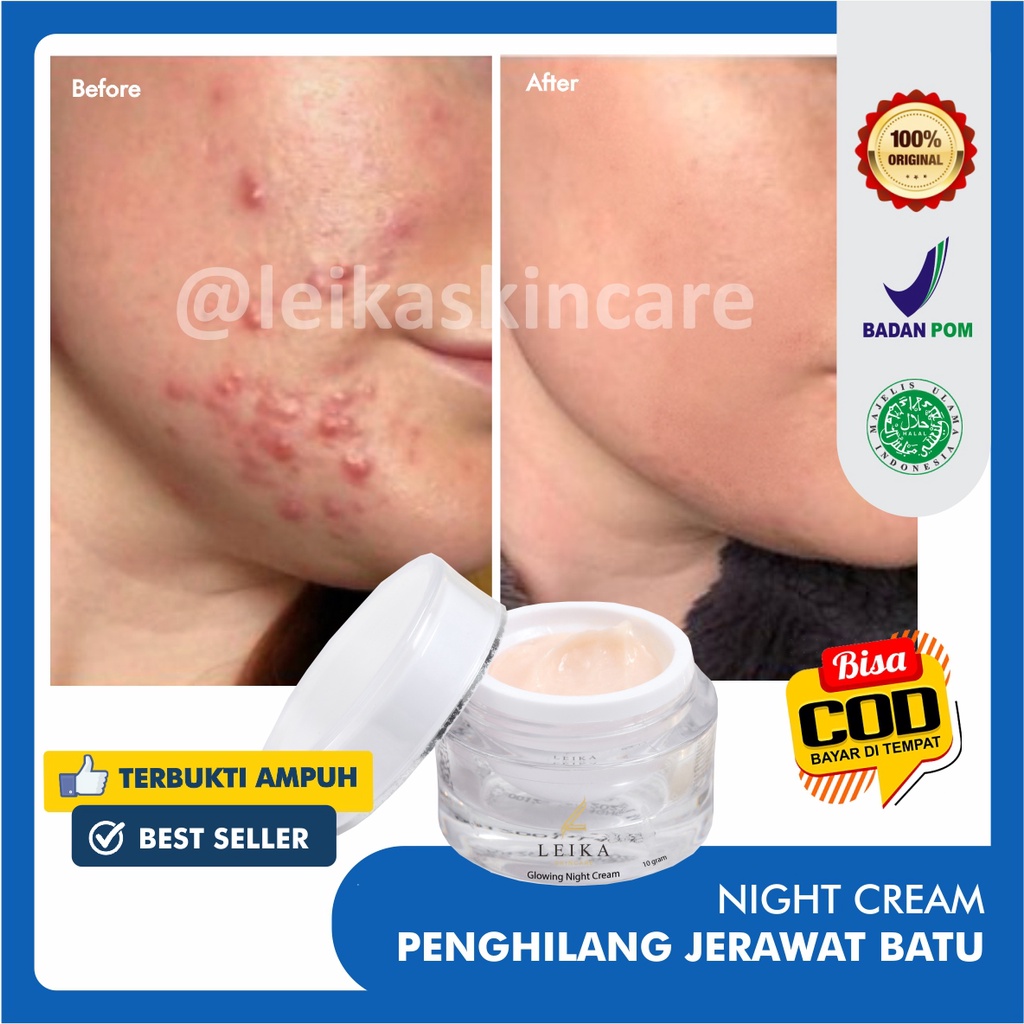 Zoya cosmetics acne daily cream · 5. Jual Cream Penghilang Jerawat Penghilang Bekas Jerawat Ampuh Obat Jerawat Dan Bekas Jerawat Obat Jerawat Paling Ampuh Untuk Wanita Penghilang Jerawat Dan Bekas Jerawat Glowing Night Cream Leika Skincare Resmi Bpom Cream