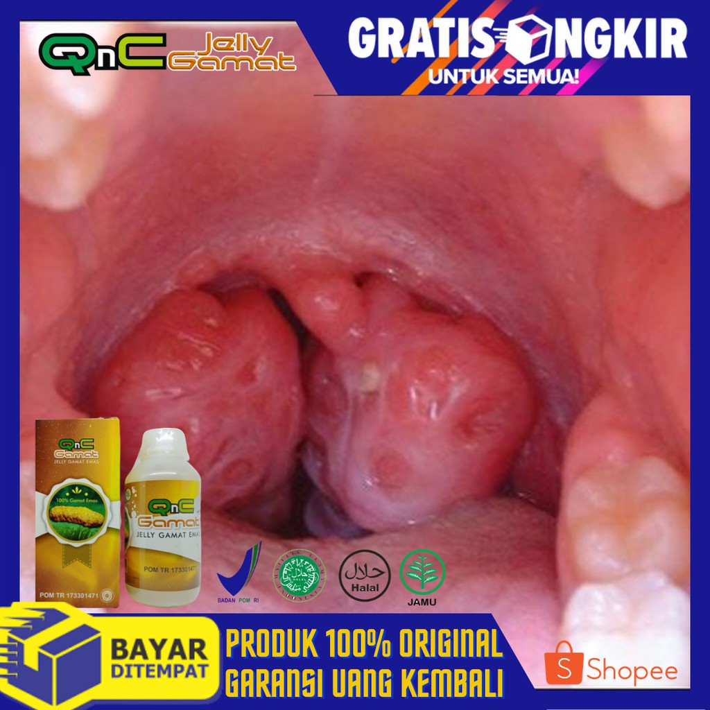 Beli obat tenggorokan sakit saat menelan terlengkap harga murah december 2021 di tokopedia! Obat Amandel Tonsilitis Radang Tenggorokan Sakit Tenggorokan Susah Menelan Leher Kaku Dll Shopee Indonesia