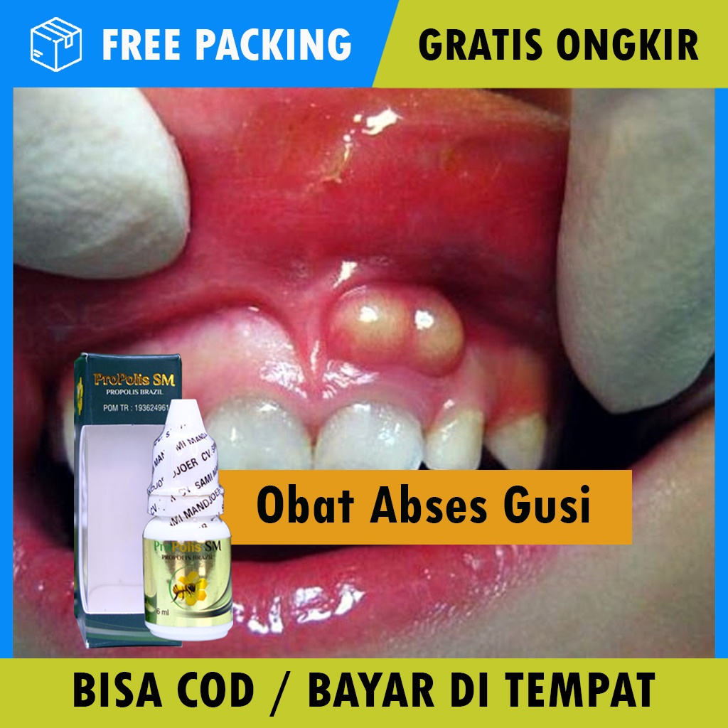 Gusi selalu bengkak dan tidak kunjung sembuh · 1. Jual Bisa Cod Obat Abses Gusi Pada Anak Dewasa Obat Abses Gusi Bernanah Alami Obat Untuk Abses Gusi Tak Kunjung Sembuh Abses Gusi Bengkak Benjolan Bernanah Di Gusi Pereda Nyeri Benjolan Di