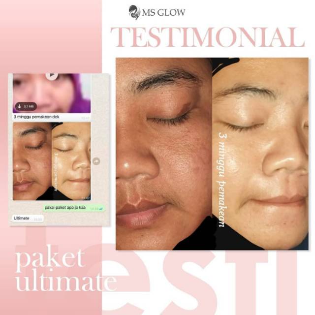 Best produk skincare ms glow untuk atasi kulit kering dan kusam!! Jual Ms Glow Paket Ultimate D Khususkan Buat Kamu Yg Punya Kulit Berminyak Kusam Flek Dan Ad Anti Aging Indonesia Shopee Indonesia