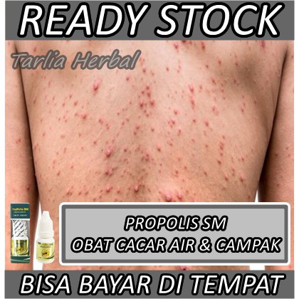 Rosehip oil adalah minyak esensial yang diekstrak dari biji dan daun tanaman . Harga Bekas Cacar Terbaru November 2021 Biggo Indonesia