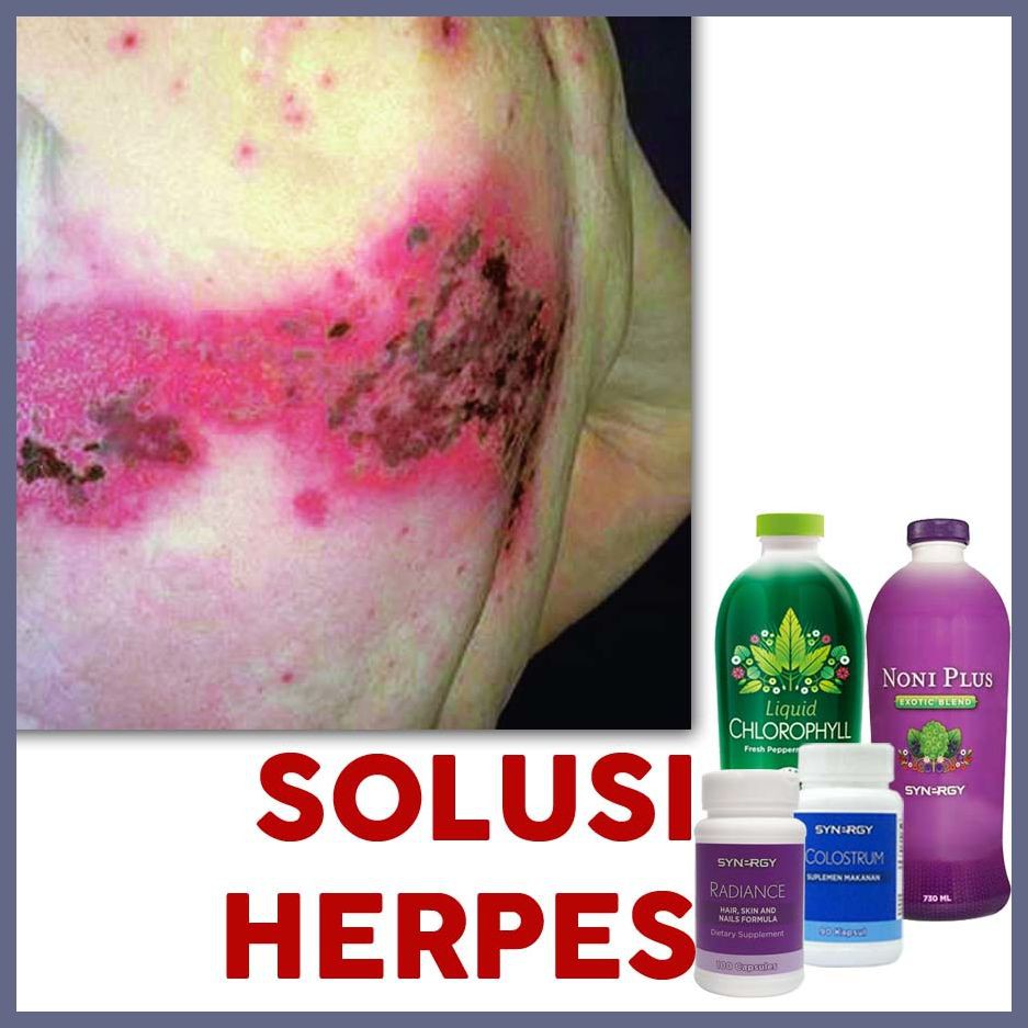 Muka perot, kelainan kulit, telinga berdenging, vertigo, mual, . Obat Herpes Alami Di Wajah Dan Leher Menghaluskan Kulit Shopee Indonesia
