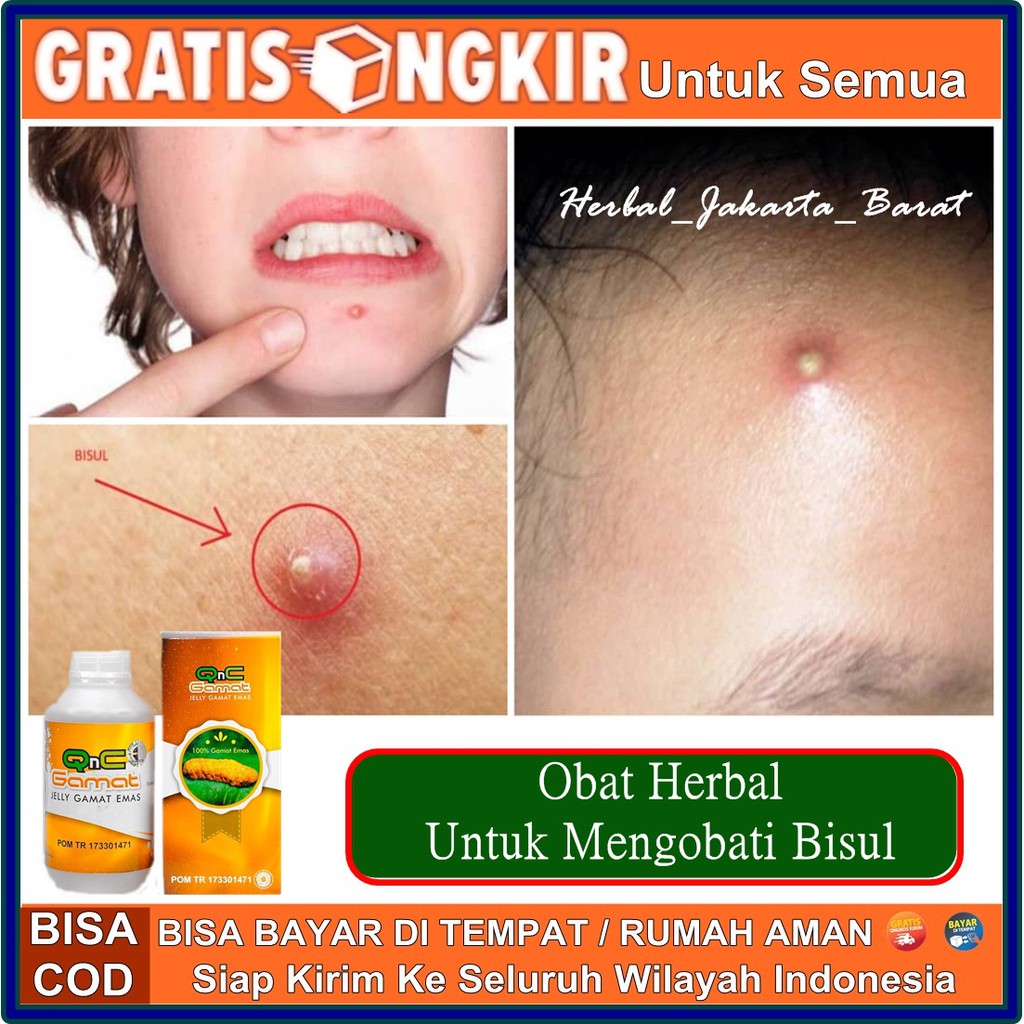 Dengan obat herbal propolis brazil sm, bisul pada anak hilang dan kesehatanya terjaga. Qnc Obat Bisul Besar Tanpa Nanah Bisul Sudah Pecah Tapi Masih Bengkak Bisul Tidak Punya Mata Shopee Indonesia