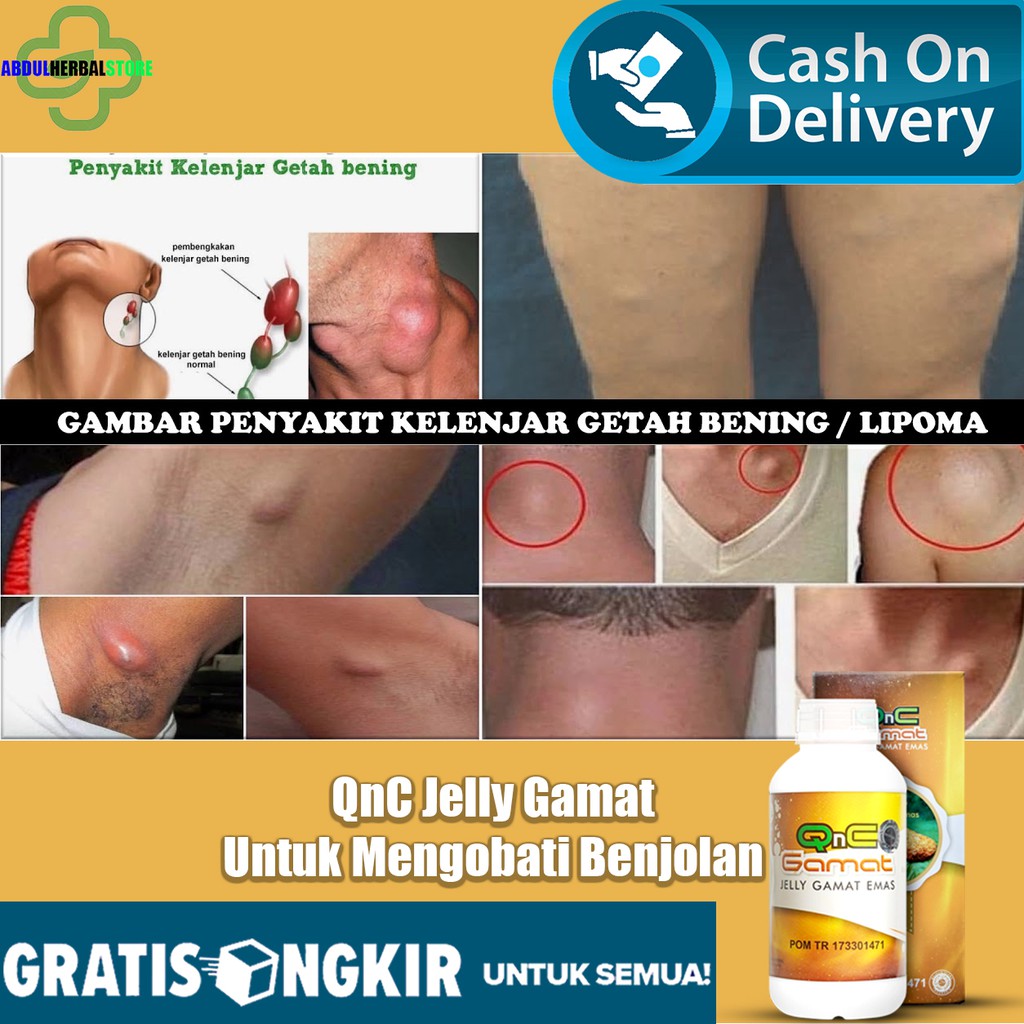 Kandungan antioksidan yang ada pada kulit manggis bisa. Jual Obat Tradisional Uci Uci Penghilang Ganglion Uci2 Penghancur Limfoma Kelenjar Getah Bening Miom Indonesia Shopee Indonesia