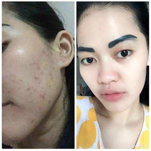 Banyak pengguna cream pemutih wajah yang telah menjadi korban produsen yang . Hn Krim Shopee Indonesia