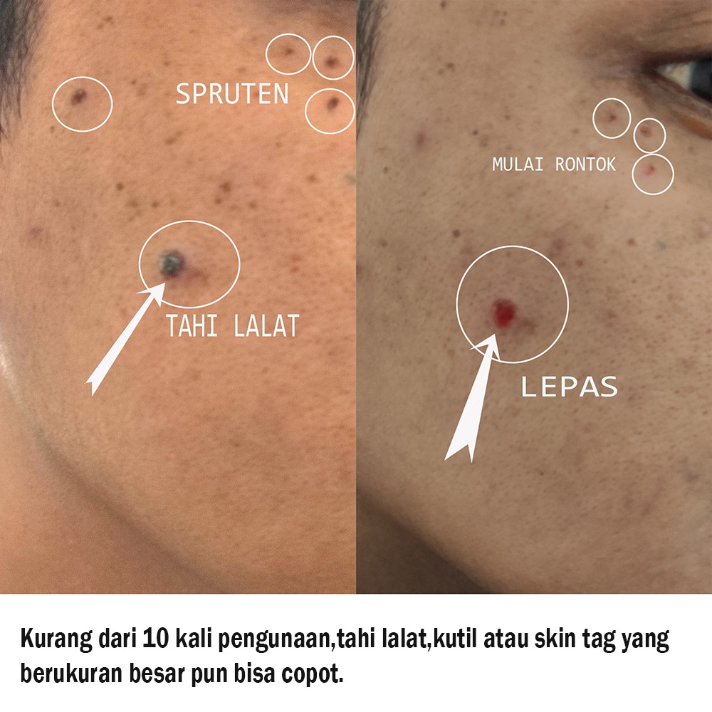 Pada keadaan melanoma yang terdeteksi . Jual Obat Penghilang Tahi Lalat Kutil Skintag Spruten Ampuh Permanen Racikan Tradisional Alami Dan Aman Indonesia Shopee Indonesia