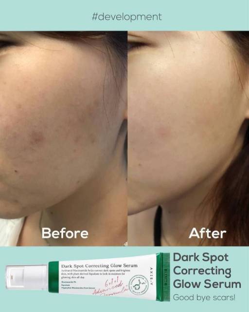 Weil's illuminating complex, it helps visibly minimize dark. Axis Y Dark Spot Correcting Glow Serum Shopee Indonesia