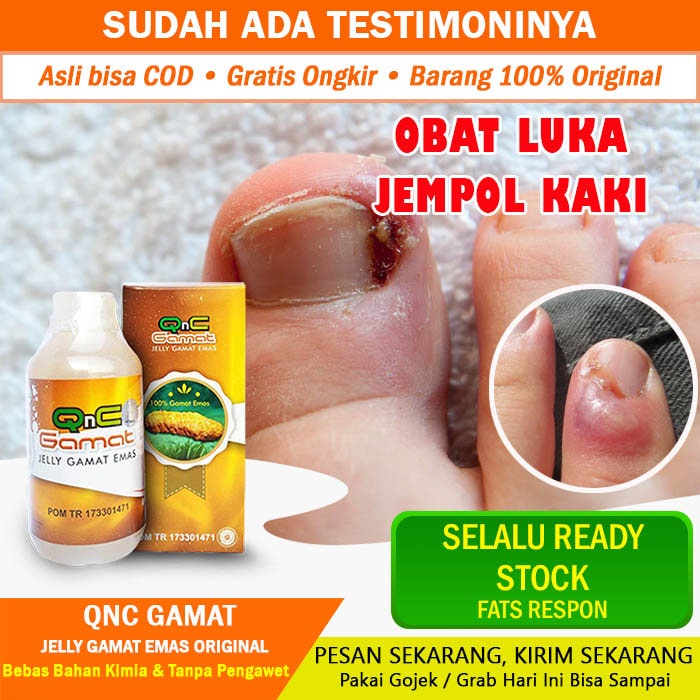 Dok sudah 5hari jempol kaki saya bernanah, awalnya dari pecah dan. Obat Cantengan Kuku Jempol Kaki Luka Cantengan Cantengan Kuku Tangan Obat Luka Bernanah Obat Bodo Eusi Esi Obat Luka Infeksi Qnc Jelly Gamat Asli Shopee Indonesia