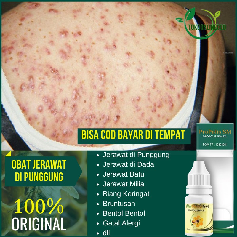 Kompres hangat berfungsi untuk membuka folikel rambut sekaligus . Jual Obat Jerawat Punggung Dada Badan Bokong Pantat Bruntusan Biang Keringat Anak Dan Dewasa Propolis Sm Indonesia Shopee Indonesia