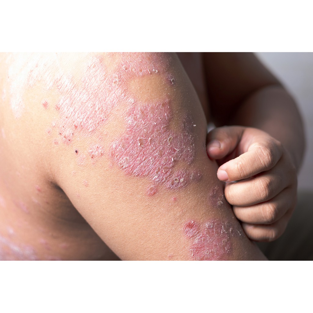 Penyakit Kulit Kurap