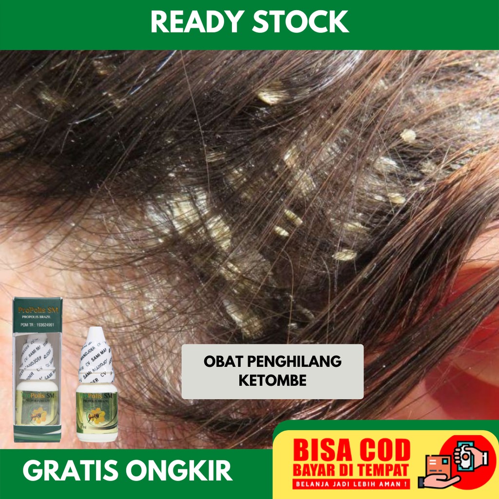 Harga Ketombe Propolis Sm Terbaru Juli 2021 | BigGo Indonesia